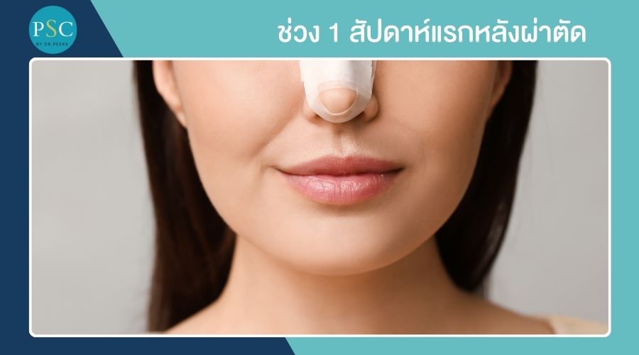 ช่วง 1 สัปดาห์แรกหลังผ่าตัด