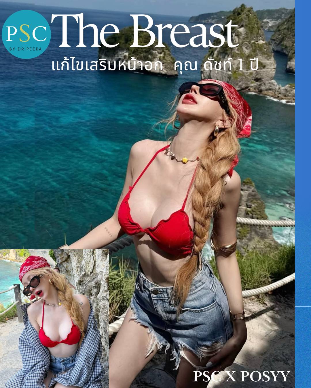 แก้ไขหน้าอก คุณดัทช์