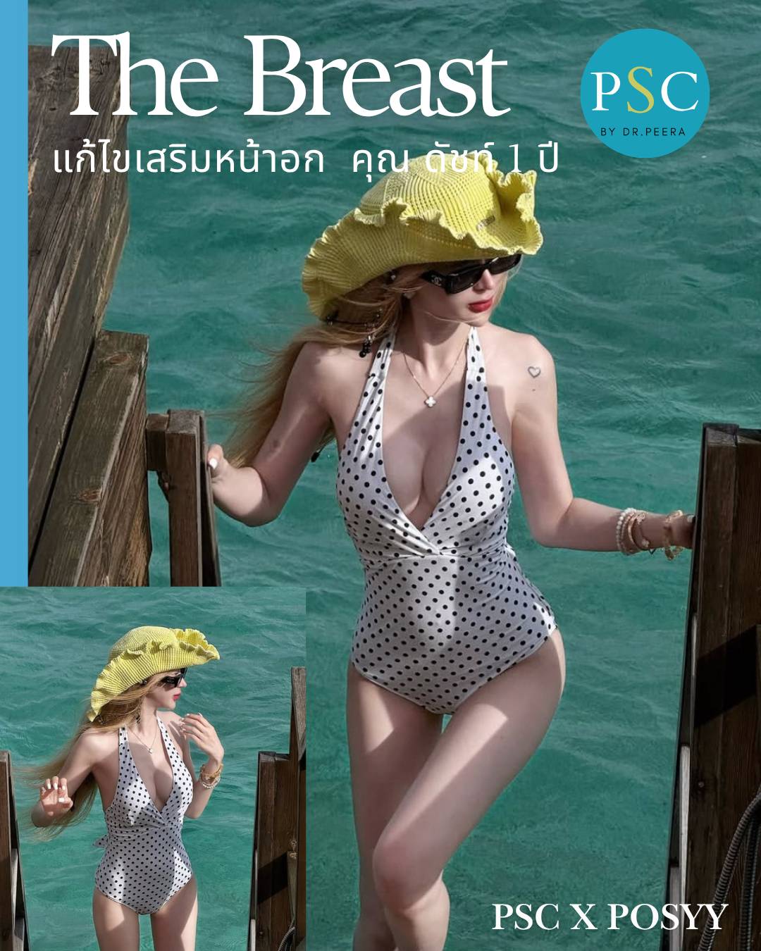 แก้ไขหน้าอก คุณดัทช์