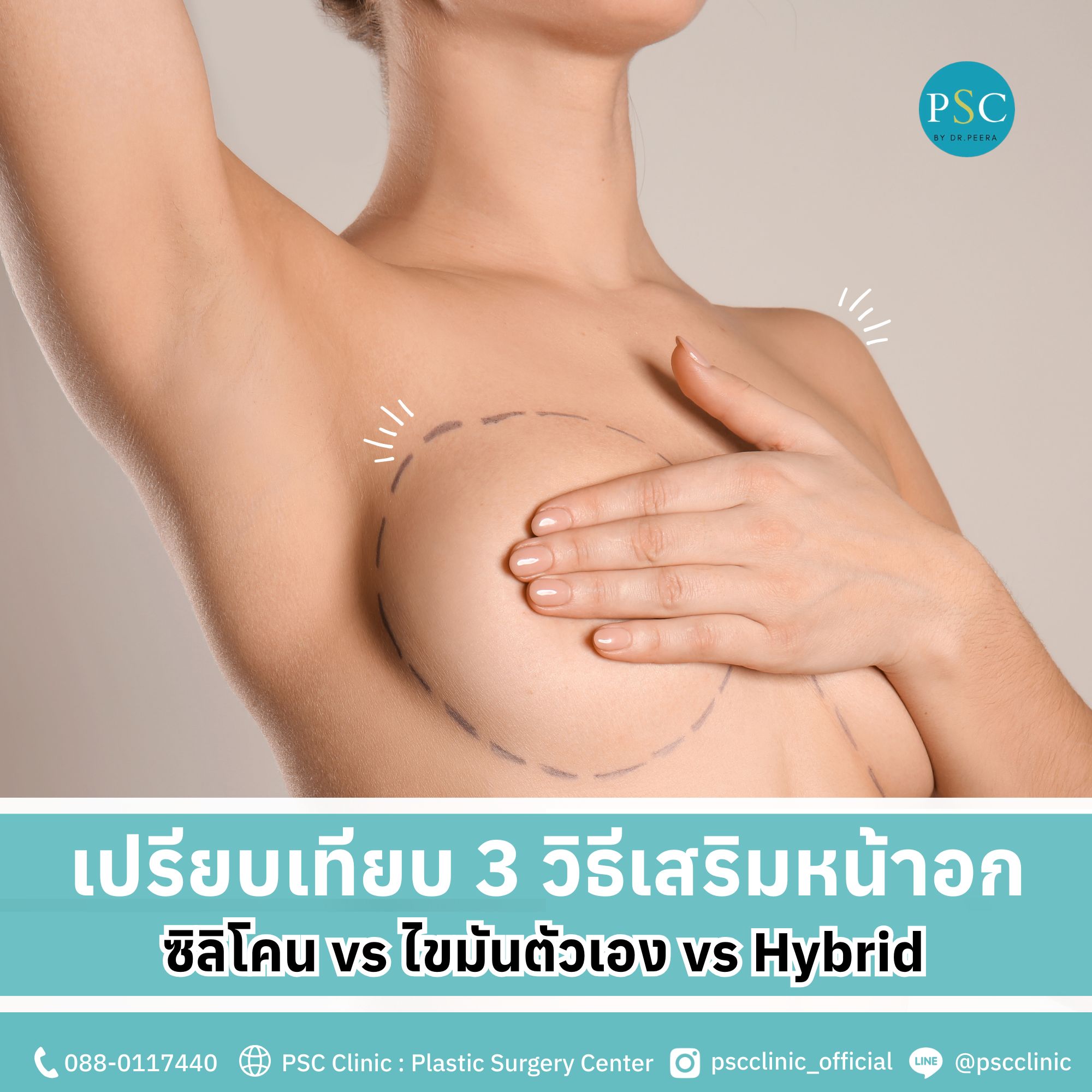 เปรียบเทียบ 3 วิธีเสริมหน้าอก