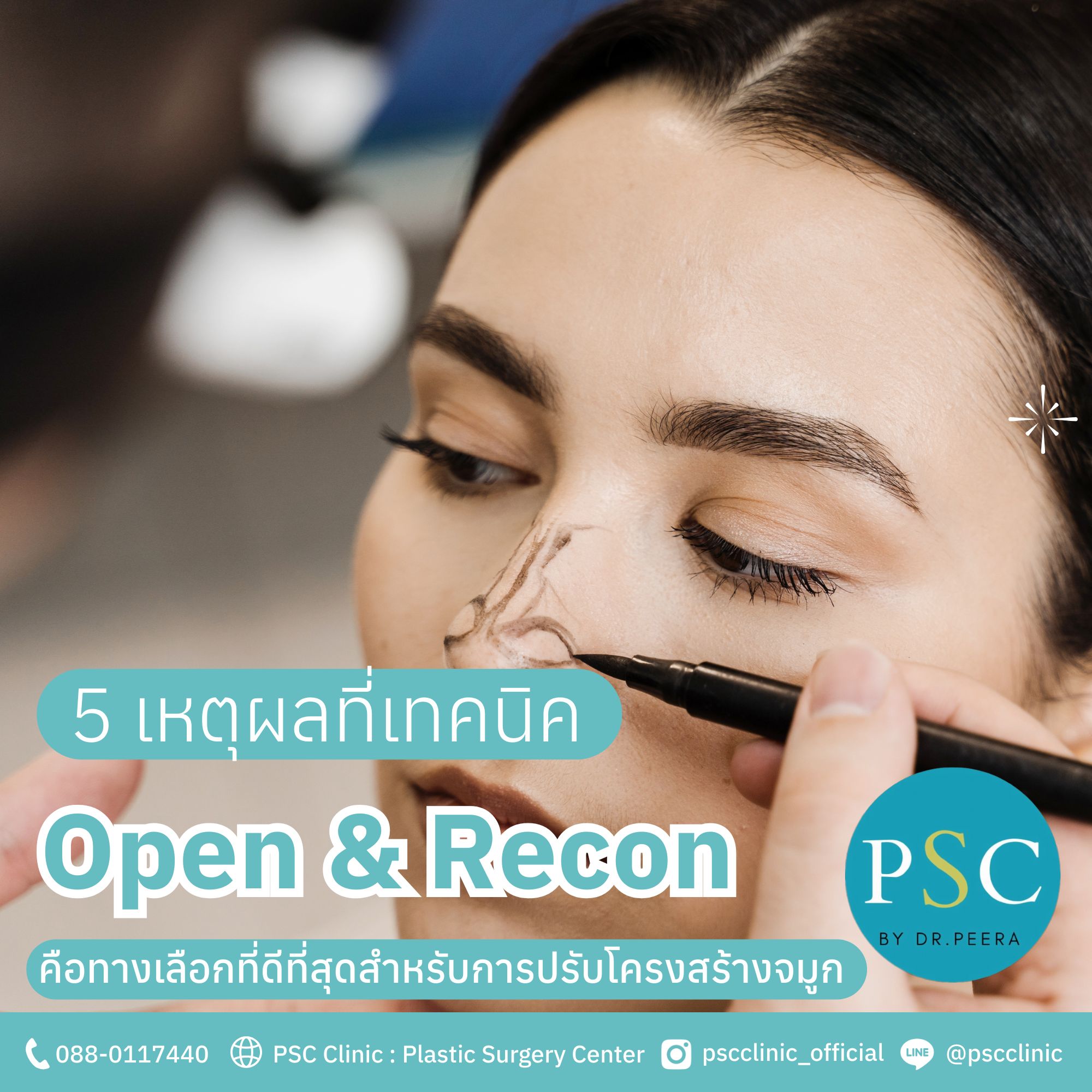 5 เหตุผลที่เทคนิค Open & Recon คือทางเลือกที่ดีที่สุดสำหรับการปรับโครงสร้างจมูก