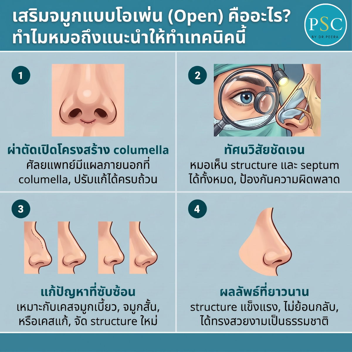 เสริมจมูกแบบโอเพ่น (Open) คืออะไร? ทำไมหมอถึงแนะนำให้ทำเทคนิคนี้