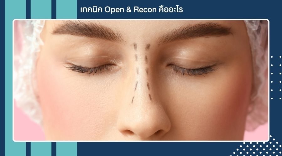 เทคนิค Open & Recon คืออะไร
