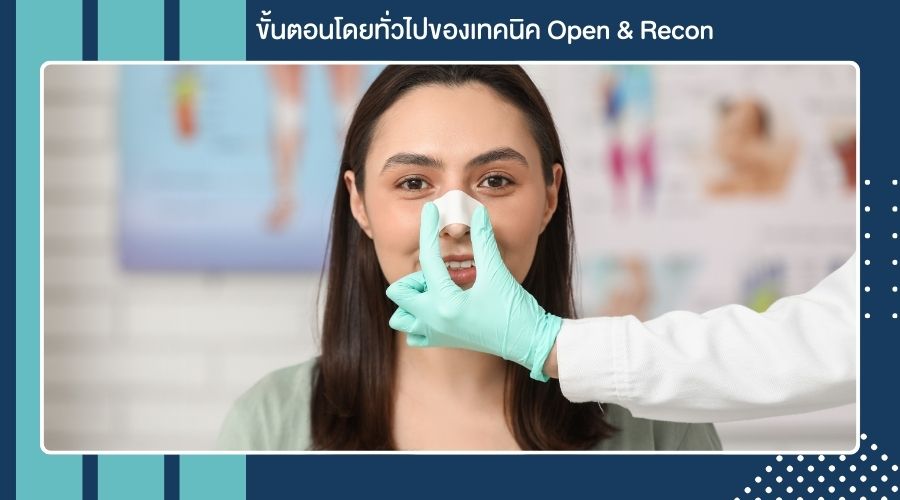 ขั้นตอนโดยทั่วไปของเทคนิค Open & Recon
