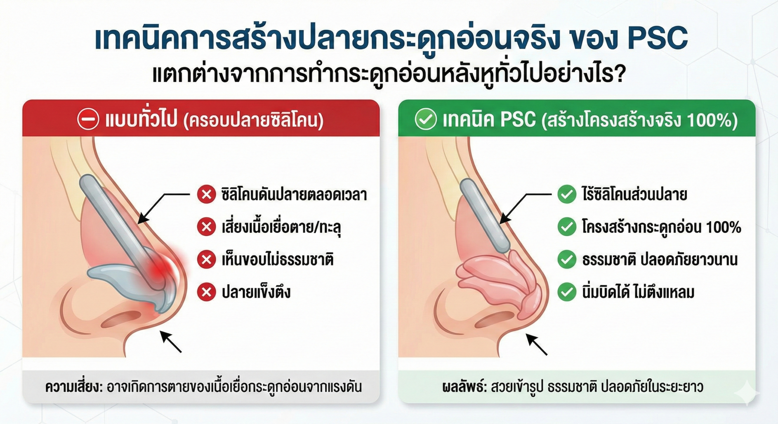 เทคนิค PSC (สร้างปลาย 100%)