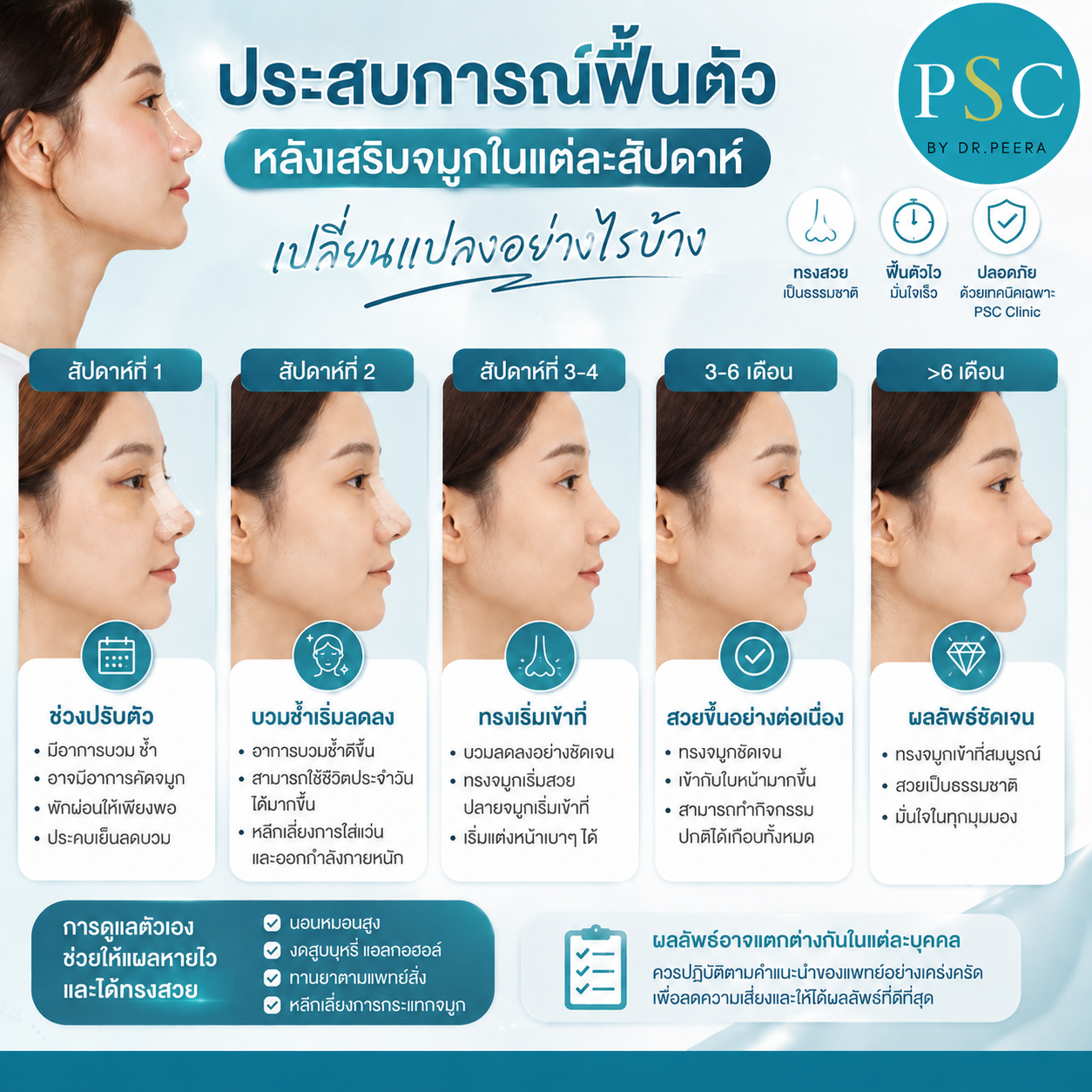 ประสบการณ์ฟื้นตัวหลังเสริมจมูกในแต่ละสัปดาห์ เปลี่ยนแปลงอย่างไรบ้าง